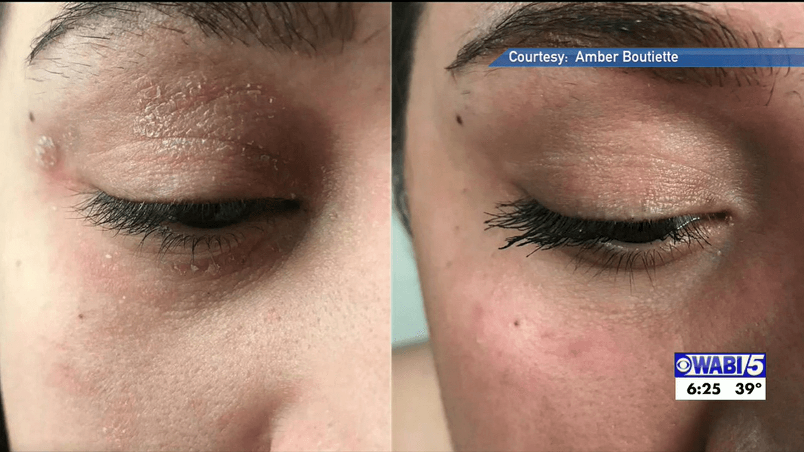 Before-and-after close-ups of a closed eyelid showing flaky, red skin; Courtesy: Amber Boutiette — WABI5 6:25 39°