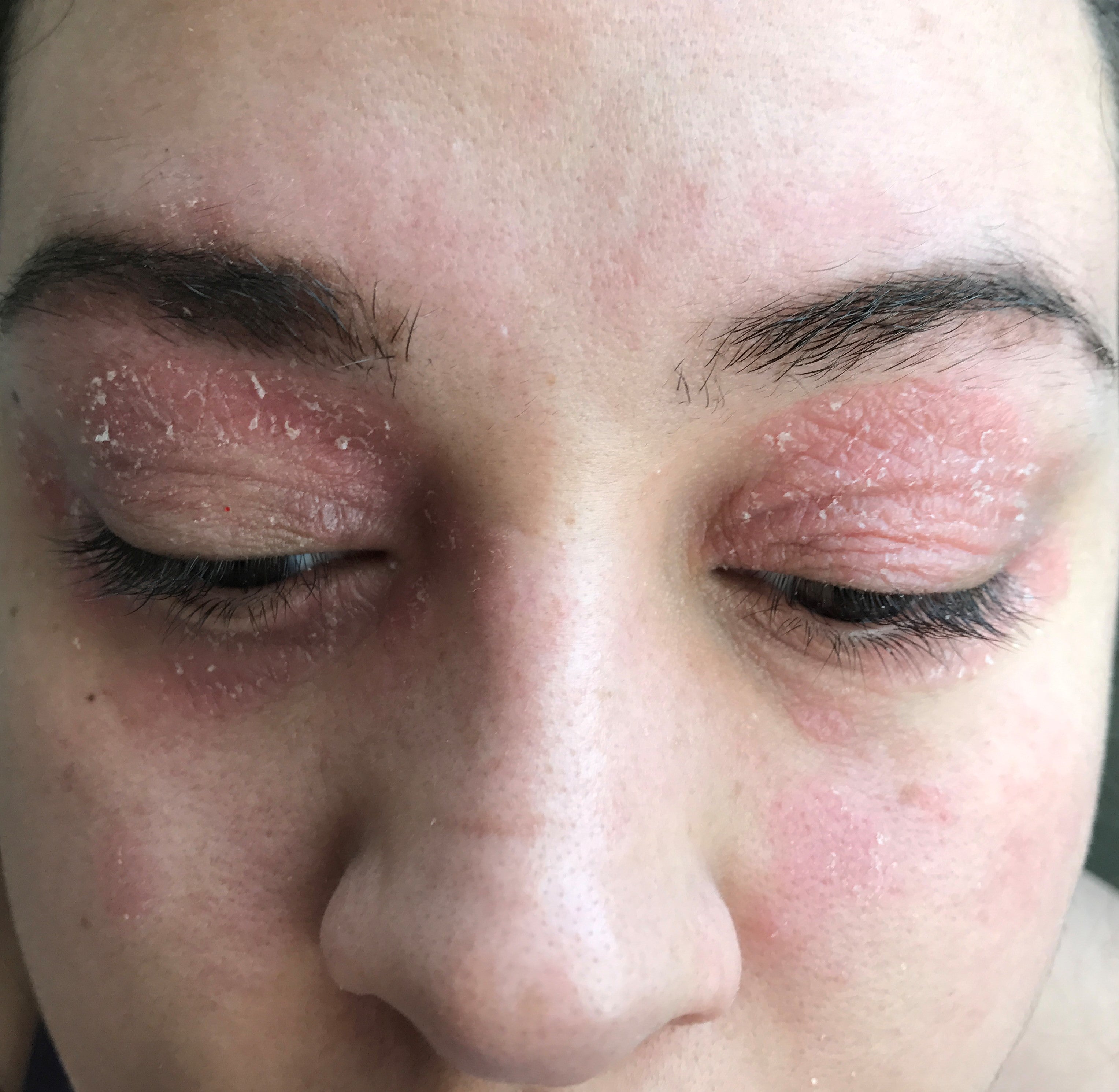 Close-up of closed eyelids with red, peeling dry skin and white flaky patches along lids and under-eye