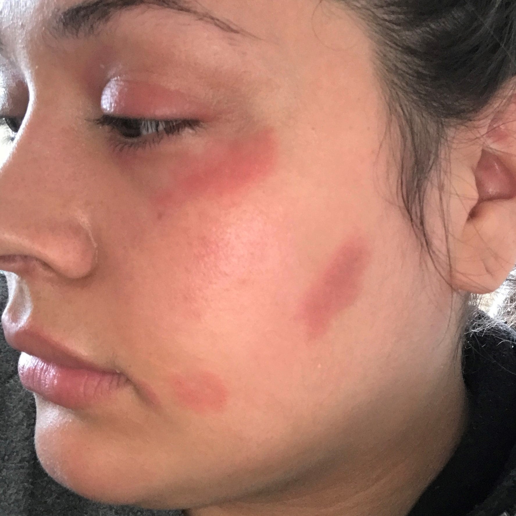 Side-profile before-treatment photo showing facial skin texture and redness