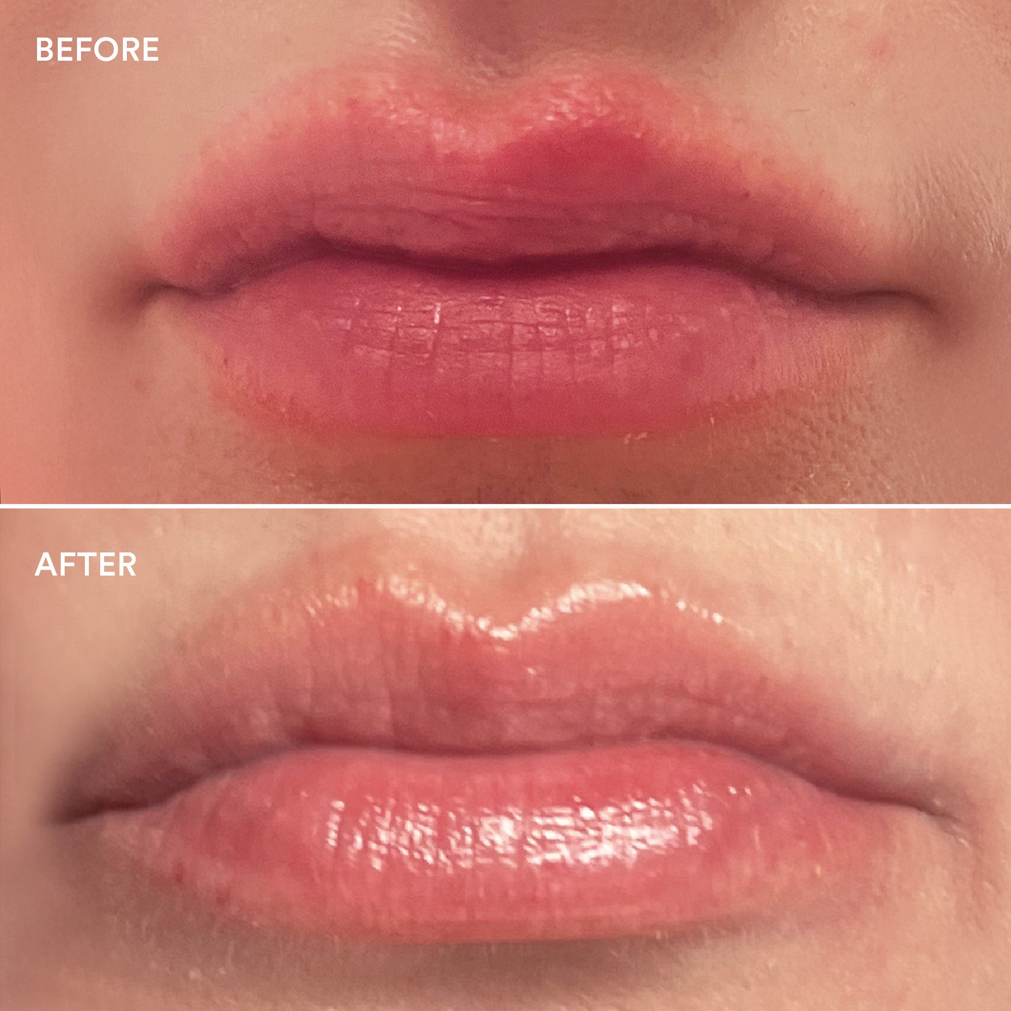 Lip Treatment