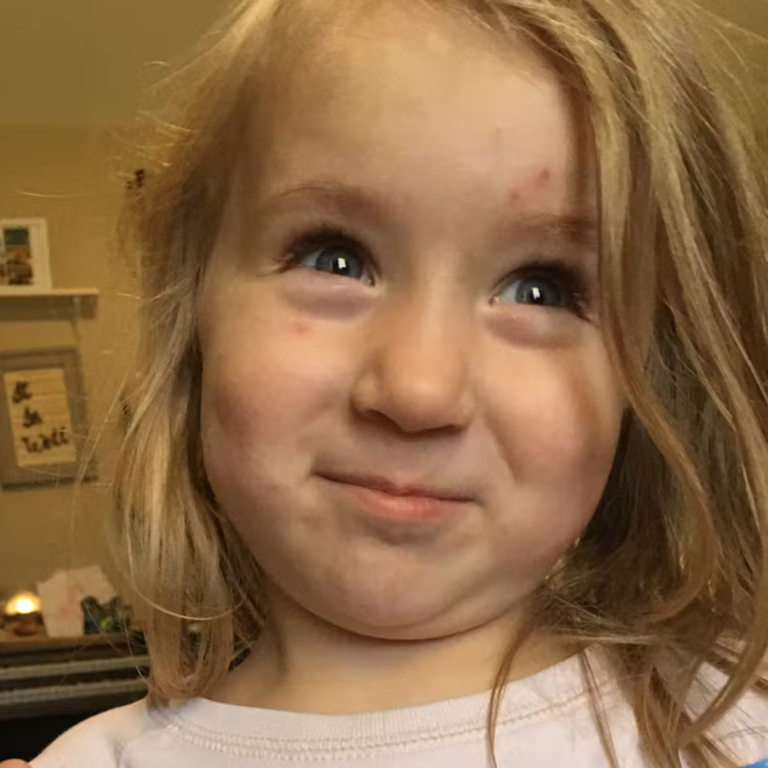 Ashlie, Mom — close-up of a smiling young girl with light hair and faint red marks on her forehead