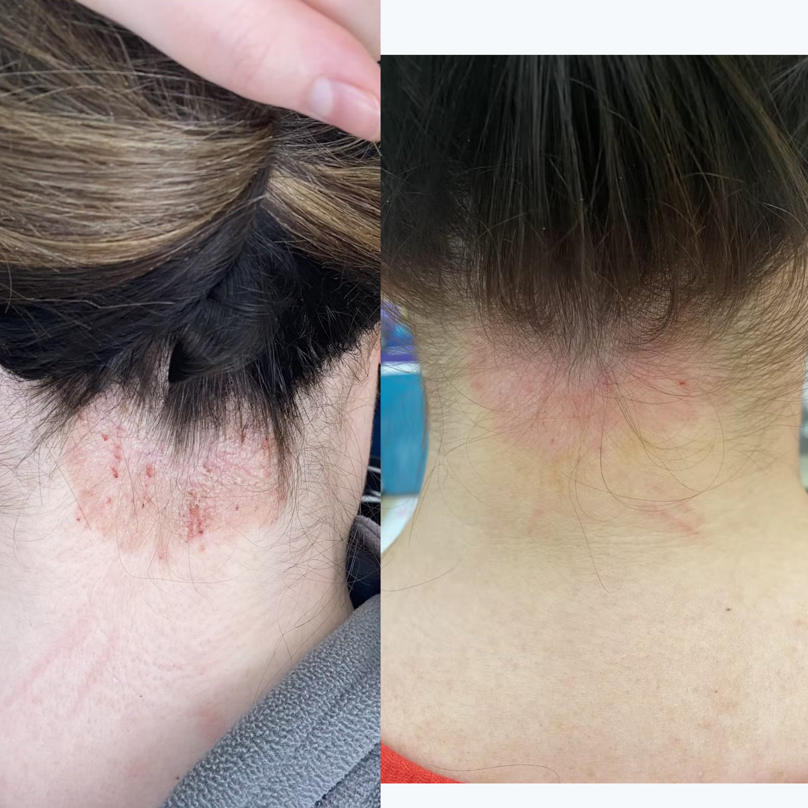 Before-and-after of irritated nape: scaly red rash with crusting (left) and reduced redness after treatment (right)