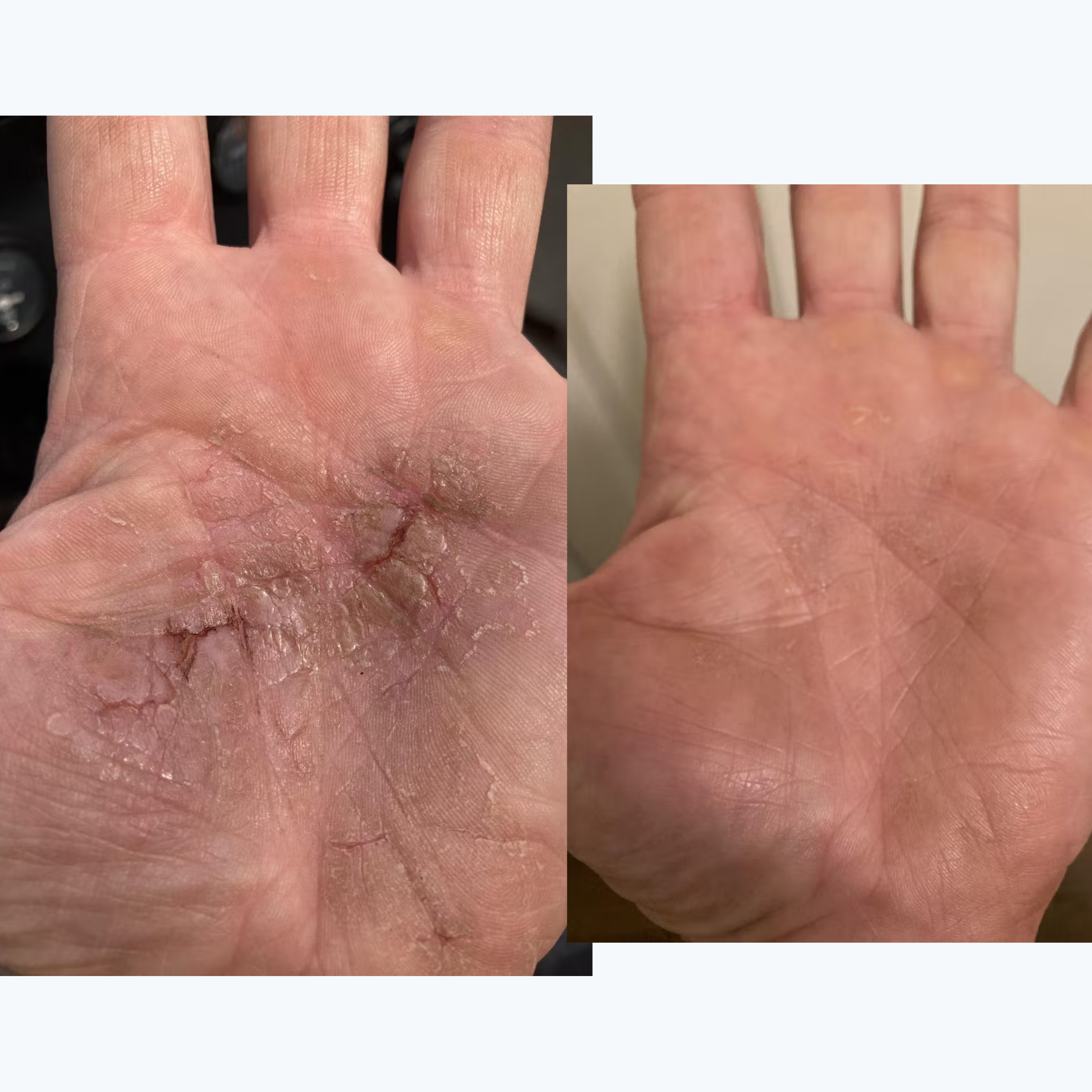 Before-and-after: Scot's palm showing cracked, flaky skin (left) and healed palm (right)