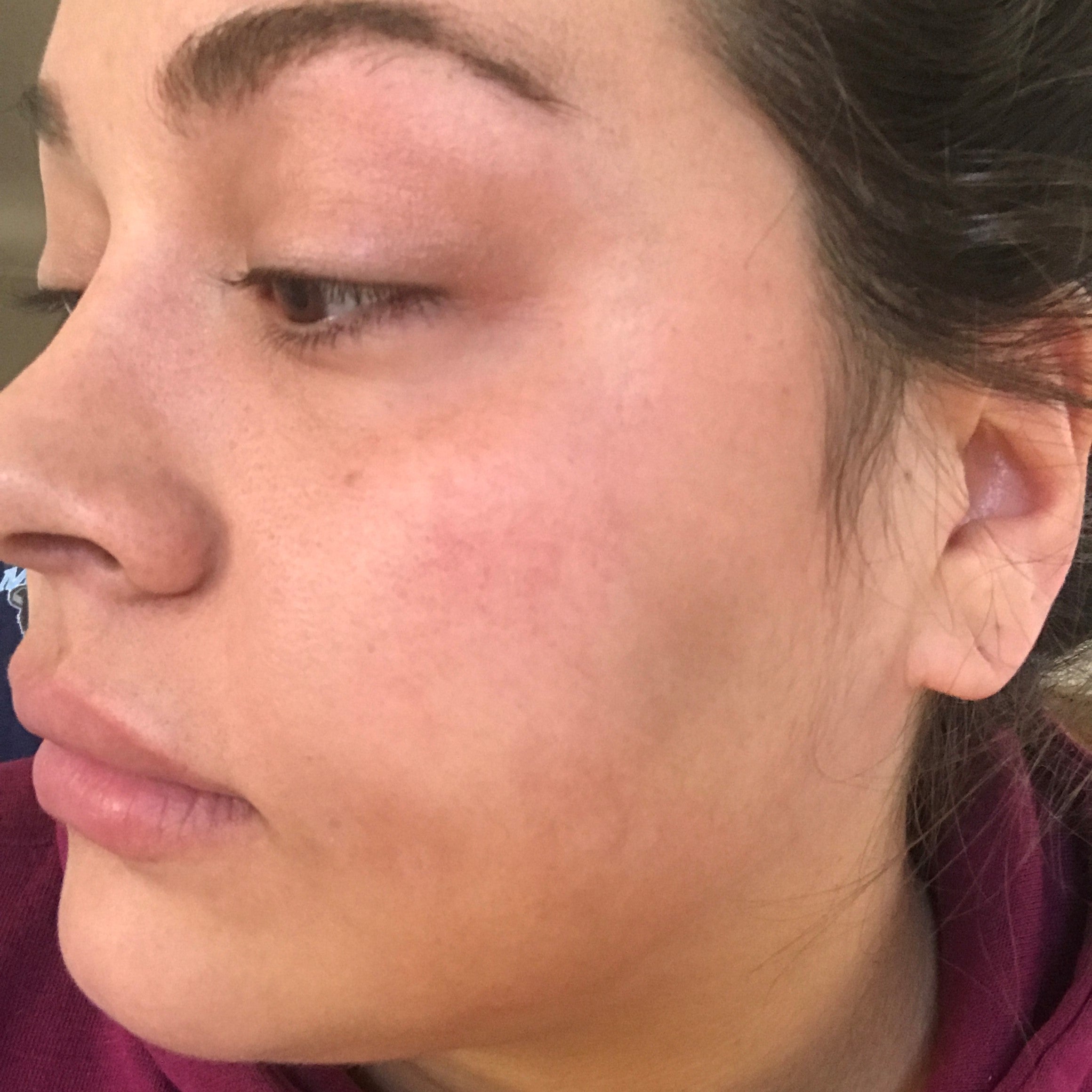 Side view of a person's treated skin after procedure